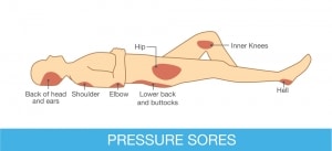 Deep Tissue V. Pressure Injury / The Steele Law Firm
